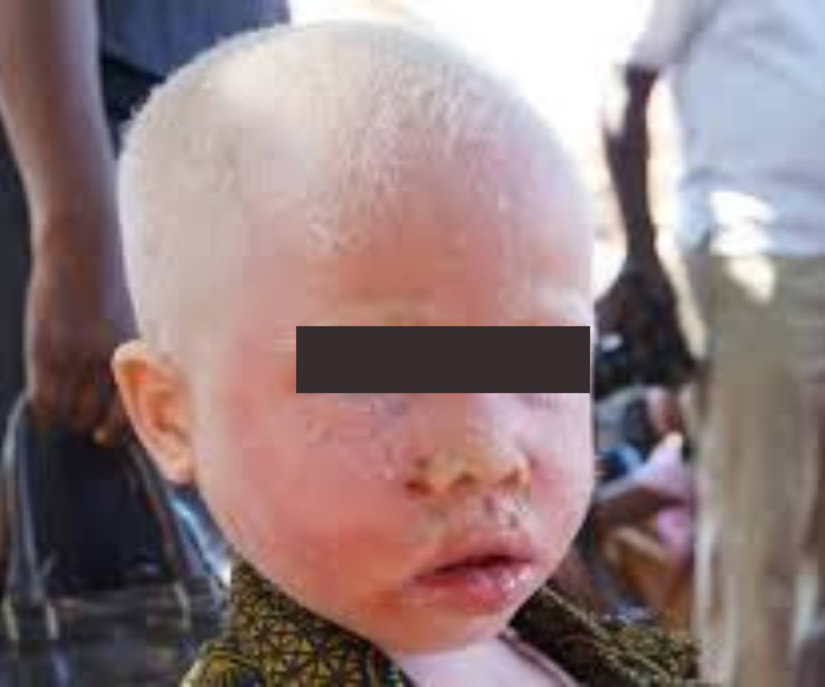 L'albinisme : une maladie complexe et stigmatisante - Sud Quotidien
